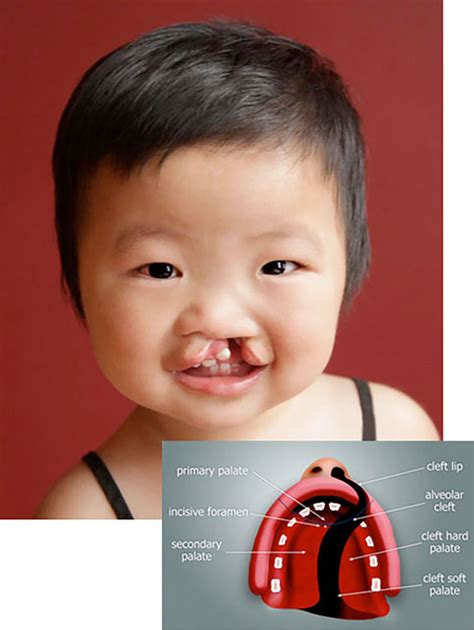 Cleft Lip and Palate – Orthodontics Dental Treatment