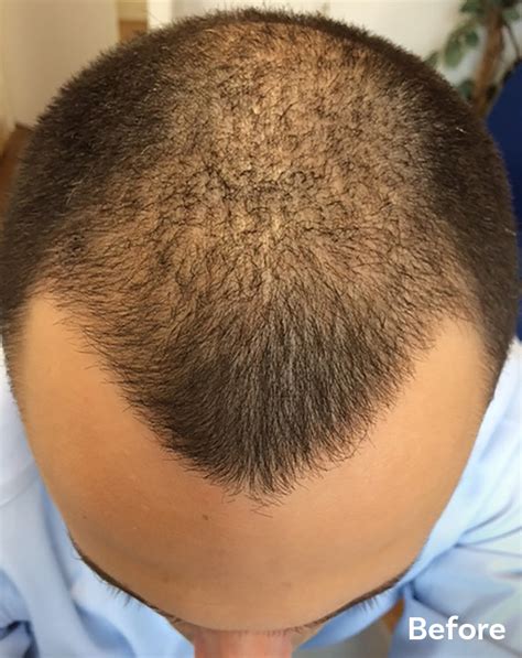 Scalp Micropigmentation and Hair Transplants | Skalp