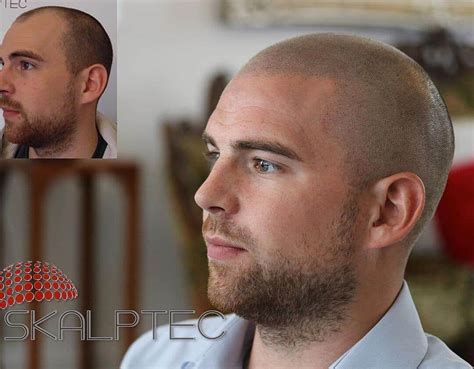 Scalp Micropigmentation Near Me | Skalptec Ltd | SMP UK