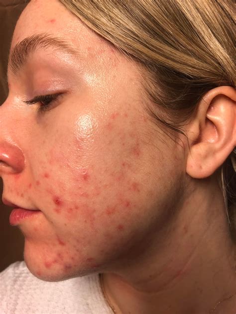 What Is Acne Exoriée? How Skin-Picking Led Me to an OCD Diagnosis | Allure