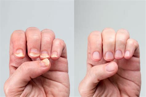 3 Things to help with Nail Fungus. | Elim Spa Products