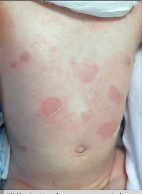 Figure 1 from A Case of Staphylococcal Scalded Skin Syndrome in a 1 ...