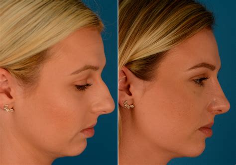 Rhinoplasty Photos | Naples, FL | Patient 14133