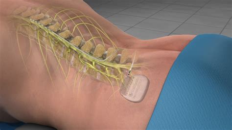 Spinal Cord Stimulator — EPIC PAIN MANAGEMENT