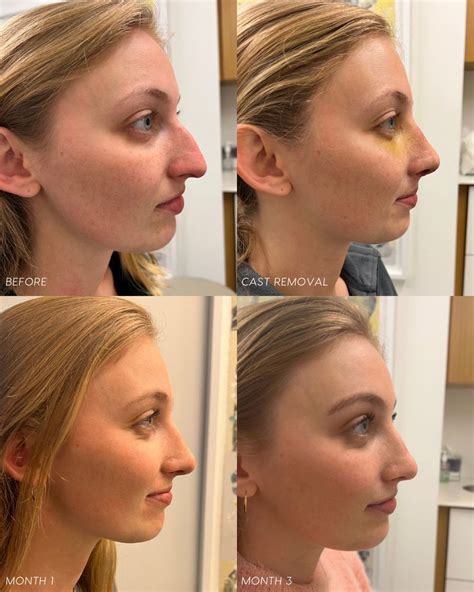 Rhinoplasty nose job experience before after recovery – Artofit