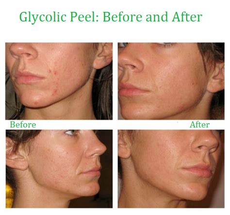 35 Glycolic Acid Chemical Peel Kit Medical Grade 100 Pure Acne Scars ...