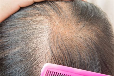 Thinning hair: Causes, types, treatment, and remedies