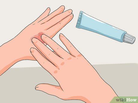 4 Ways to Treat a Hand Burn - wikiHow