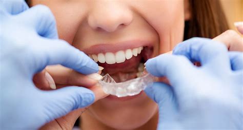 What Are the Different Types Of Teeth Alignment Methods Available ...