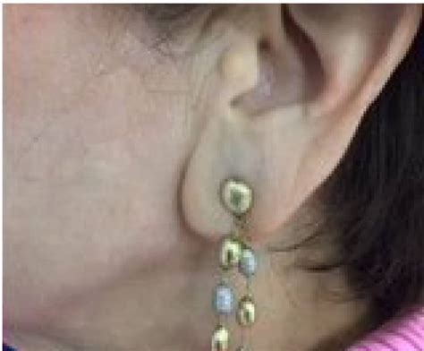 Earlobe Repair After Case 73681 - Sobel Skin