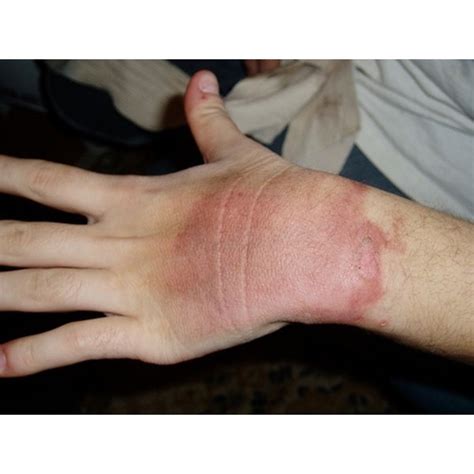 How to Treat First Degree Burns | Healthfully