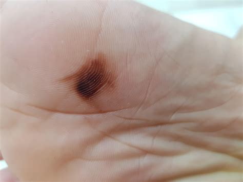 Just found out this under my foot , is this melanoma? : r/Melanoma