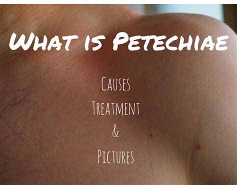Pinpoint Red Dots on Skin, This Could Be Petechiae