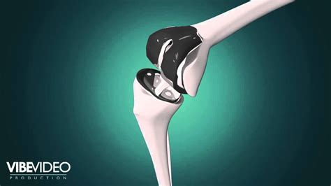 Knee Replacement Animation - YouTube
