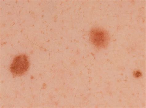 Melanoma pictures by stages, stage 0-1-2-3-4 melanoma pictures, melanoma in situ picture ...