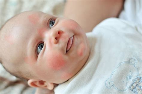 12 Symptoms Of Egg Allergy In Babies And Their Treatment | Diva baby ...