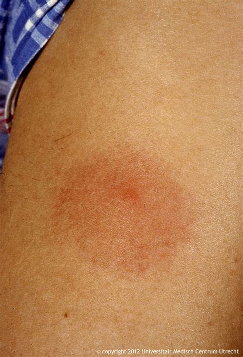 Bulls Eye Rash / A Full Guide On Lyme Disease And Why It Causes Fatigue AND ... / Fever, chills ...