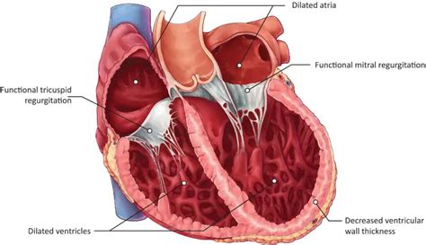 Systolic Heart Failure: Symptoms, Causes, Diagnosis, Treatment & Prevention | Treat, Cure Fast