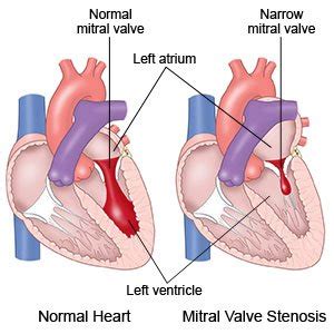 Mitral Stenosis - What You Need to Know