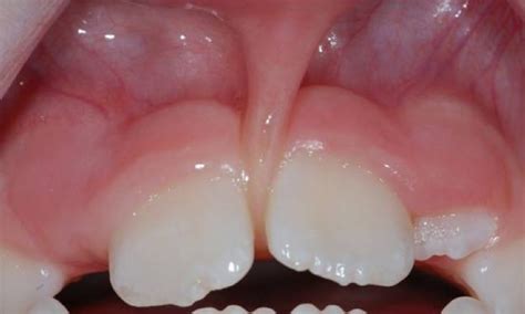 Frenectomy | Frenectomy - Kazemi Oral Surgery | Facialart.com