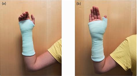 Colles Fracture Splint