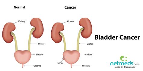 Urinary Bladder Cancer: Causes, Symptoms And Treatment