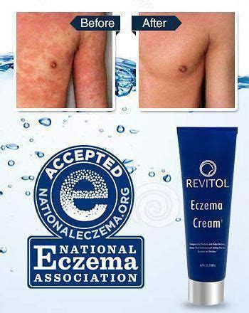 best eczema cream #besteczematreatmentforadults #besteczemacreams | Best cream for eczema ...