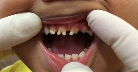 You Will Be Shocked by What Caused This Child’s Massive Tooth Decay!