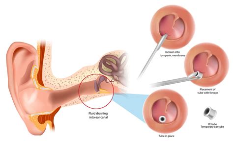 Grommets for Children — North View ENT | Dr Sebastian Ranguis | ENT Surgery Northbridge Sydney