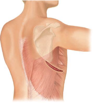 Open Resection of Esophageal Leiomyoma and GIST | Thoracic Key