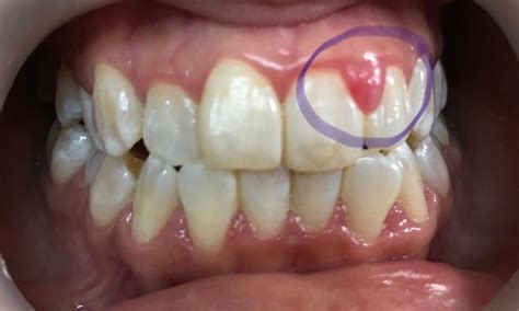Gum swelling – Shenton Dental Surgery