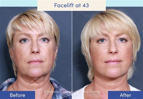 Facelift Before & After Photos: What a Facelift Looks Like at 40, 50 ...