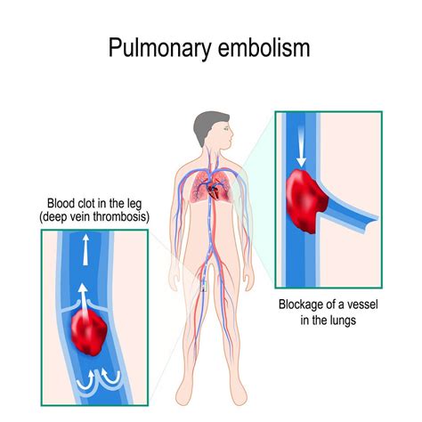 What is A Pulmonary Embolism? - Health Beat