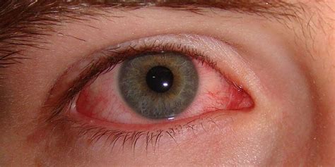 Pink Eye: Symptoms and Treatments | Coastal Eye Associates