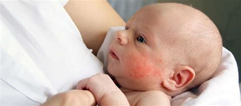 Home remedies for baby heat rash - Best 8 Remedies - APOMDIN