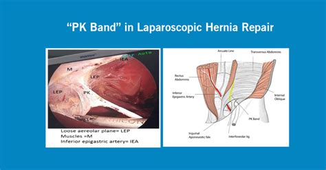 “PK Band” in Laparoscopic Hernia Repair - Dr. R. Padmakumar