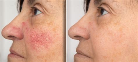 Rosacea Treatment Options at HMGS Dermatology - Heymann, Manders, Green, & Sommer