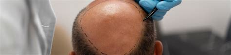 Follicular Unit Extraction (FUE) | Elite Holiday Clinic