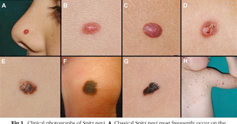 Figure 1 from Spitz nevi and other Spitzoid lesions part I. Background and diagnoses. | Semantic ...