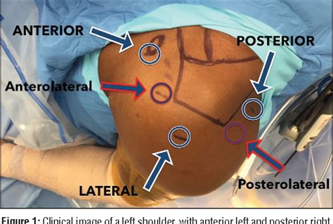 [PDF] All-Arthroscopic Superior Shoulder Capsule Reconstruction With Partial Rotator Cuff Repair ...