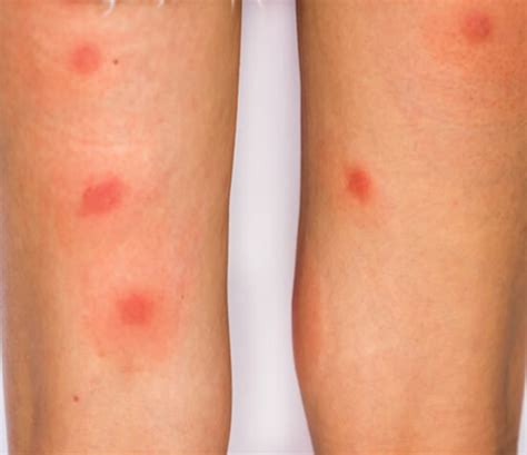 Mosquito Bites Allergy Treatment