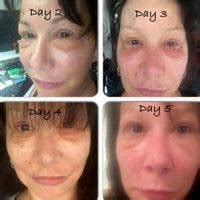 Lower Facelift Recovery Photos » Facelift: Info, Prices, Photos, Reviews, Q&A