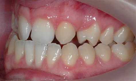 Missing both lateral Incisors with canine substitution - Platinum ...