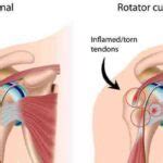 Rotator Cuff Tears - What are the Symptoms of Rotator Cuff Tears?