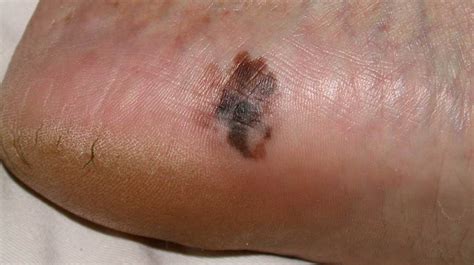 PODIATRIST DISCUSSES MELANOMAS OF THE FOOT - PODIATRIST