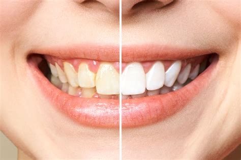 What is Dental Fluorosis, and how is it treated? - Associated Media ...