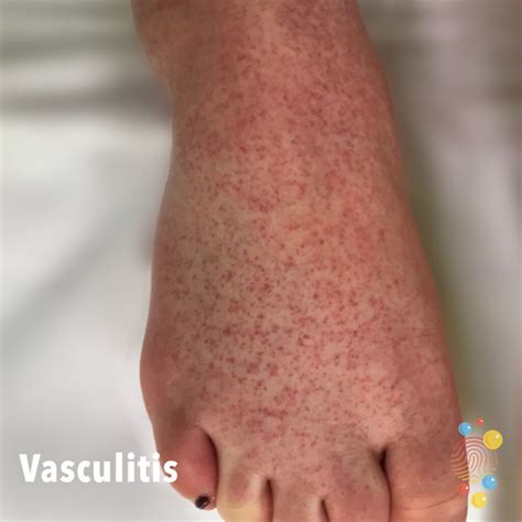 Vasculitis - Skin Deep