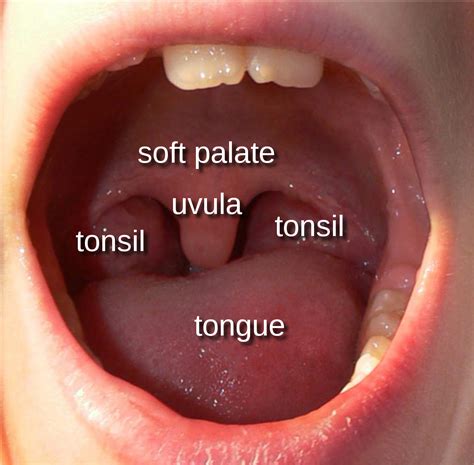 What happens if you have your uvula removed?