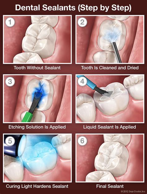 Alpharetta Dentist Discusses Benefits of Dental Sealants