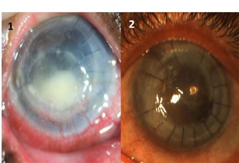 Figure 1 from STREPTOCOCCUS MITIS/ORALIS CORNEAL ULCER AFTER CORNEAL TRANSPLANTATION | Semantic ...